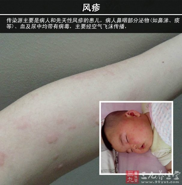 若孕妇在妊娠早期感染风疹