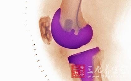 女性更年期诱发膝关节损伤 女性更年期诱发膝关节损伤