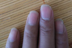 灰指甲的治疗方法 老人得了灰指甲怎么办