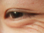 眼部细纹怎么去 眼部细纹的形成原因