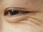 红眼病的治疗方法 老人患了红眼病应该这样做