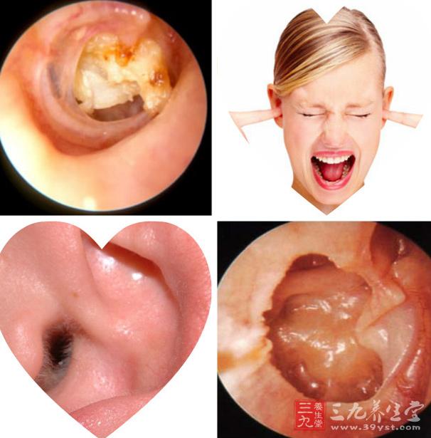 弥漫性外耳道炎急性者表现为耳痛可流出分泌物.