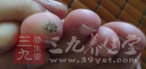 這些小秘方治療雞眼特管用