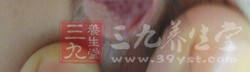 一旦月經(jīng)通調(diào)，這種眼病就不易發(fā)生