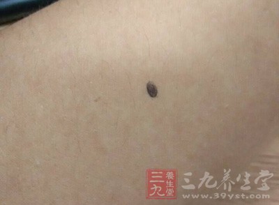 引起正常黑痣出现癌变的因素是很多的