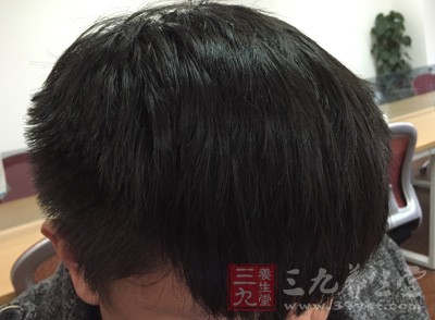油性头发 掉发根部出现小白点千万要小心 - 三九养生堂