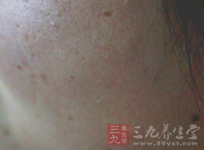 胳膊上有小红疙瘩 怎样能够去除红疙瘩(2)