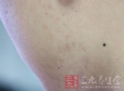 胳膊上有小红疙瘩 怎样能够去除红疙瘩