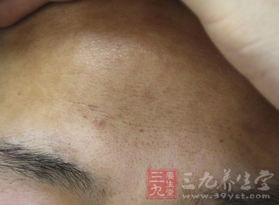 如果额头上长痘痘,这就说明这你的个人心火比较旺盛且血液循环不畅通 如果额头上长痘痘,这就说明这你的个人心火比较旺盛且血液循环不畅通