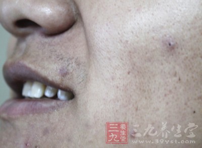 左脸颊长痘痘的情况是比较常见的 左脸颊长痘痘的情况是比较常见的
