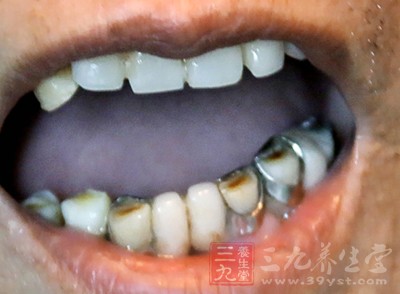 牙癌 牙齿长期磨损竟会癌变