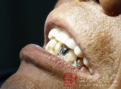 牙石 去除牙石简单又有效的方法(2)