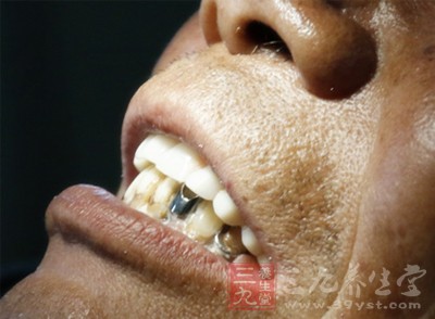 智牙冠周炎 快速消炎才能药到病除