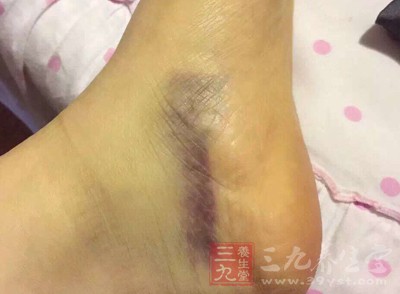 腳被開水燙了怎么辦 立即這樣做