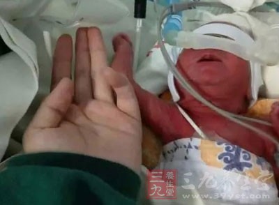 950克 贵州早产女婴仅有成人手腕大奇迹存活