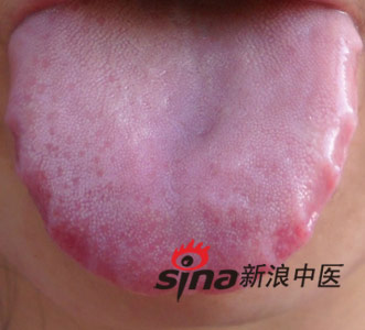 舌头辨健康 从舌头判断4类常见病症(2)