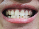 牙龈出血是什么原因