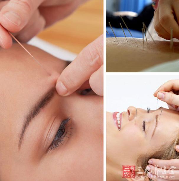 针炙减肥方法之四:体针
