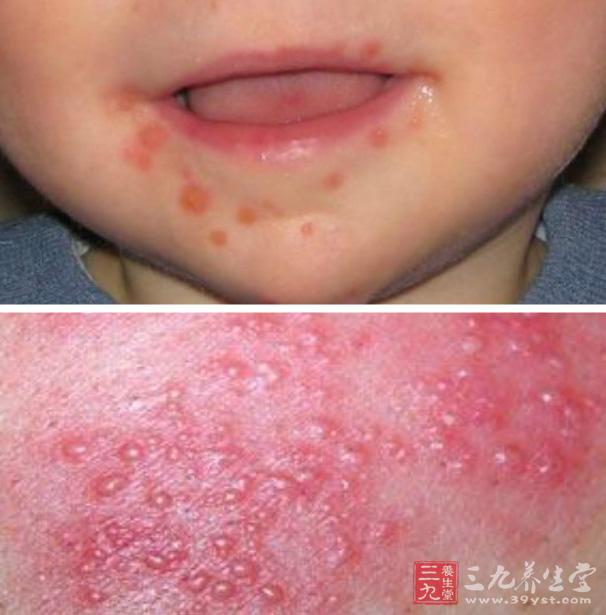 儿童疱疹分几种及图片图片