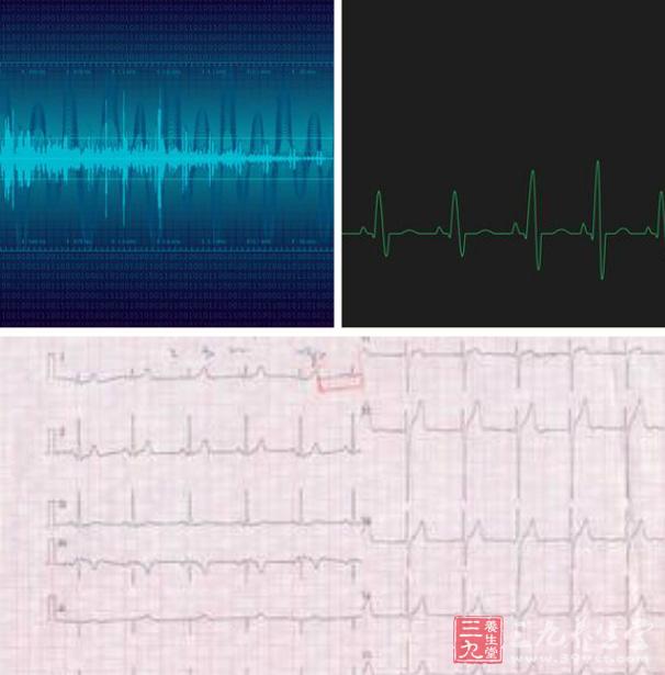 不同情绪的心电图图片