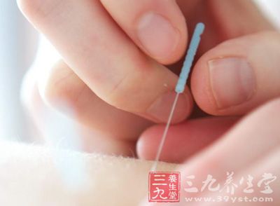 中医常识 针刺配合拔罐治荨麻疹