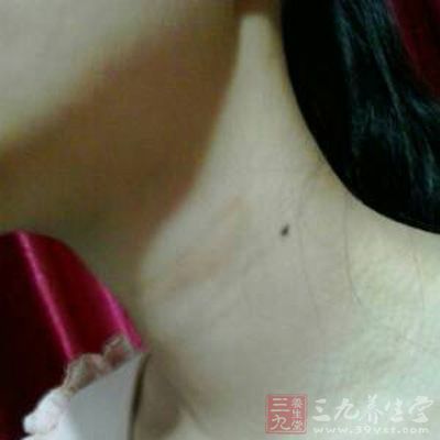 色素沉着用什么方法去除最好 1427936845143.jpg