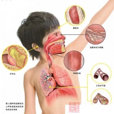 儿童呼吸道感染性疾病_儿童上呼吸道感染病历_幼年呼吸道感染病史