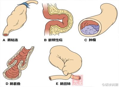 急性阑尾炎是怎么引起的