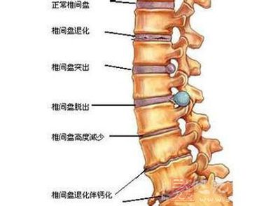 腰椎間盤突出患者中青少年佔到1/4