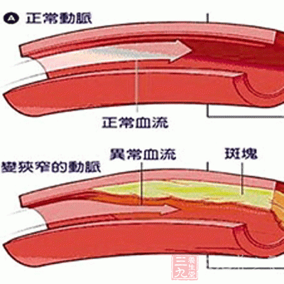 掉下來的小斑塊會在短時間內迅速堵塞血管