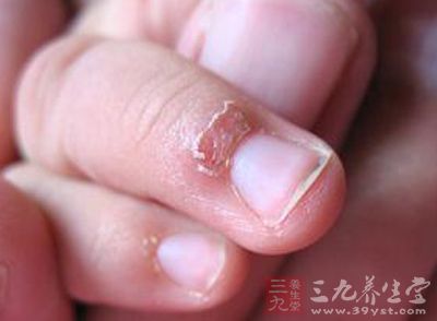 手指上的"倒刺"拔不得