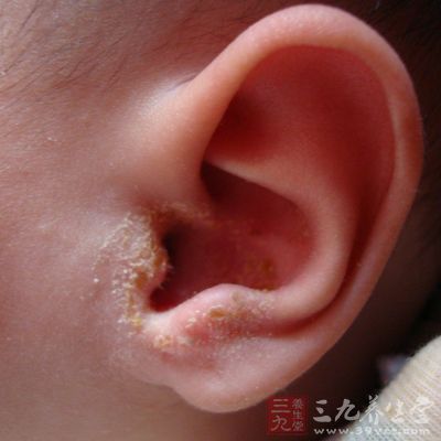 观耳朵知健康 小问题反映大疾病 