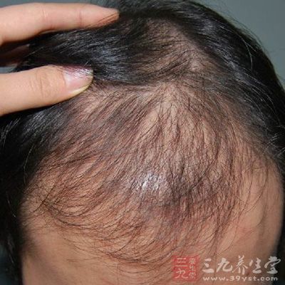 怎么样减少掉发 1437717212749.jpg
