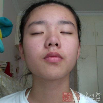 脸上的痘坑怎么弄平 1438230284195.jpg