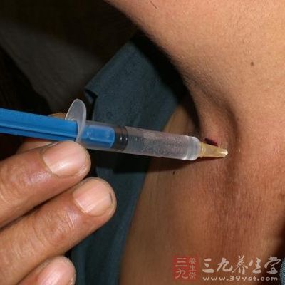 中医治疗慢性咽炎的方法(2)