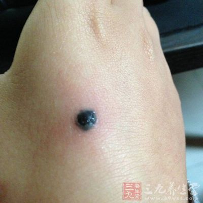 双生痣代表什么呢 1440404647277.jpg