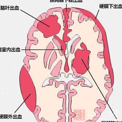脑溢血的症状表现