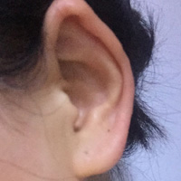 外耳湿疹的疾病查询