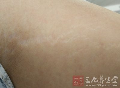 生长纹也是一种皮肤病,人的皮肤中有弹力纤维,在生长过程中导致皮肤
