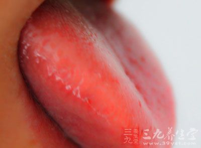 一般情况下人体在健康状态下舌头应该是薄白舌苔的淡红色
