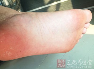 腳上起水泡怎麼辦 身體長這種水泡別亂擠當心是病