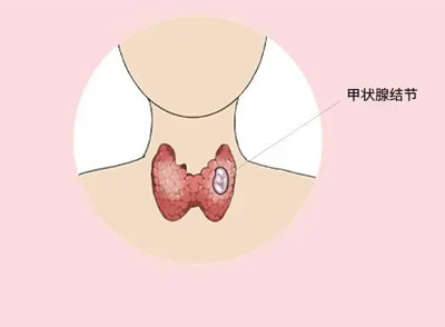 甲状腺结节也有很大的几率可能会发展成为甲状腺癌