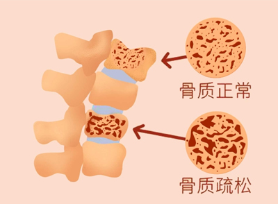 雌激素水平的下降，会加速骨质钙质的流失，疼痛感会比较明显，甚至骨质还会出现疏松的情况