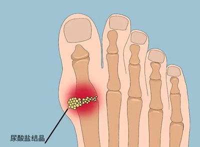 體內尿酸升高，草酸與鈣結合會形成結晶，沉積在大腳趾關節(jié)處，就會產(chǎn)生痛風石，會引起腳部疼痛，雙腳也會腫脹明顯