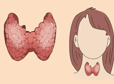 甲狀腺有結節(jié)能不能自動消失