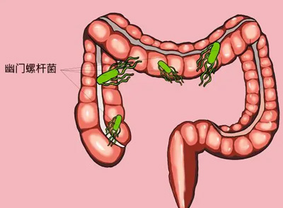 越來越多的人受到幽門螺旋桿菌影響，對于腸胃會造成很大影響