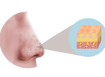 鼻子上總是擠出白色顆粒物是啥東西 有什么妙招可以清除干凈