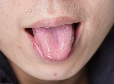 白厚舌苔到底怎么回事 原來(lái)中西醫(yī)看法竟不同
