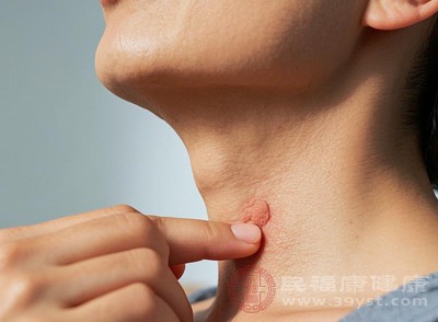 由人乳頭瘤病毒(HPV)感染引起，細(xì)長(zhǎng)如絲狀，顏色與皮膚接近或偏深，常密集出現(xiàn)在脖子、眼瞼周?chē)饋?lái)較硬，有傳染性