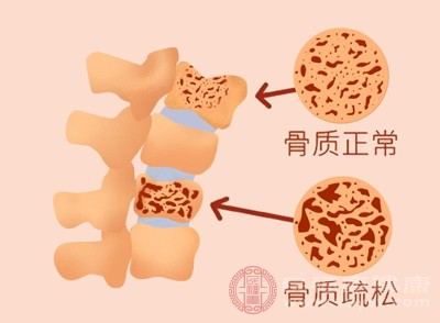骨骼為了維持正常生理功能，會釋放儲存的鈣，久而久之骨量減少，骨密度下降，引發(fā)骨質(zhì)疏松